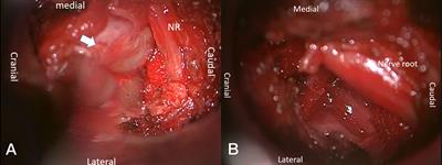 Feasibility and efficacy of spinal microtubular technique for resection of lumbar dumbbell-shaped tumors